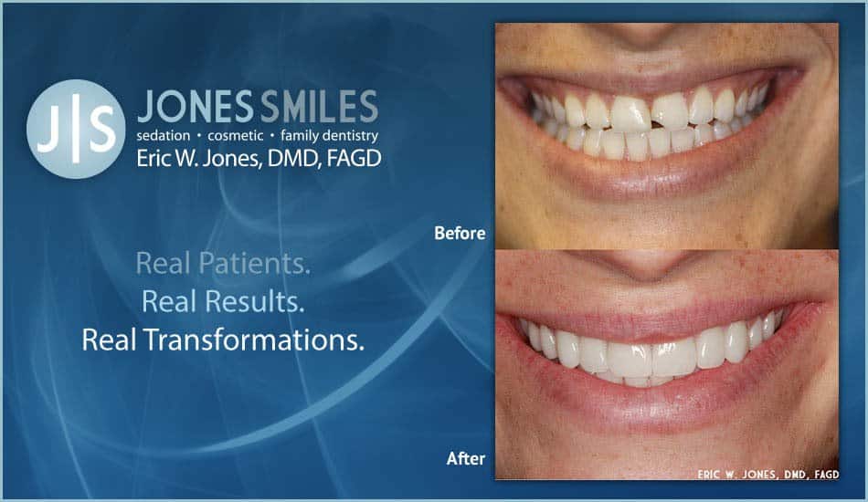 Get Your Smile Back with Dentist Buford, GA