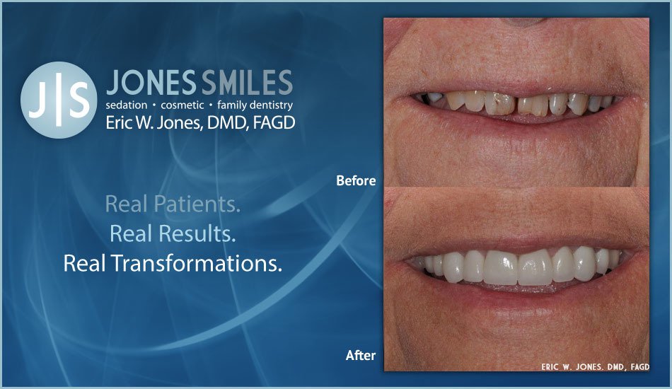 Get Your Smile Back with Dentist Buford, GA