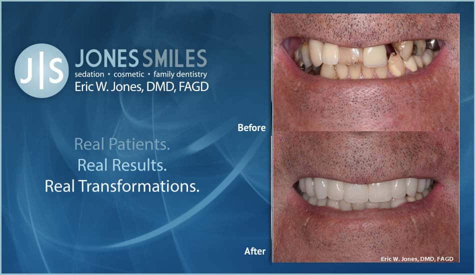 Get Your Smile Back with Dentist Buford, GA