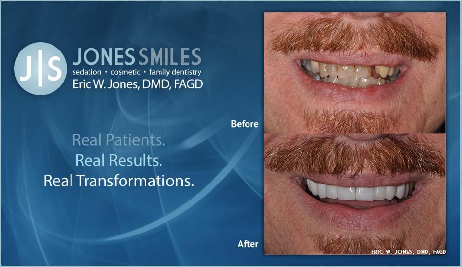 Get Your Smile Back with Dentist Buford, GA